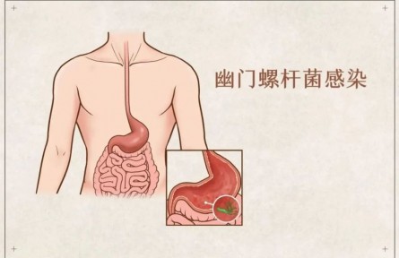辟謠 | 吃大蒜能殺幽門螺桿菌？真的假的？