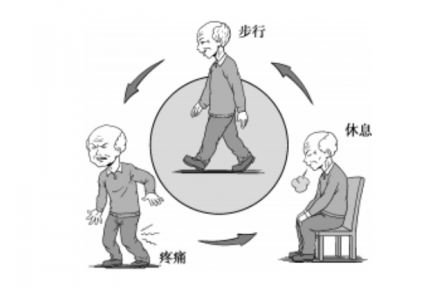 健康問答|什么是間歇性跛行？